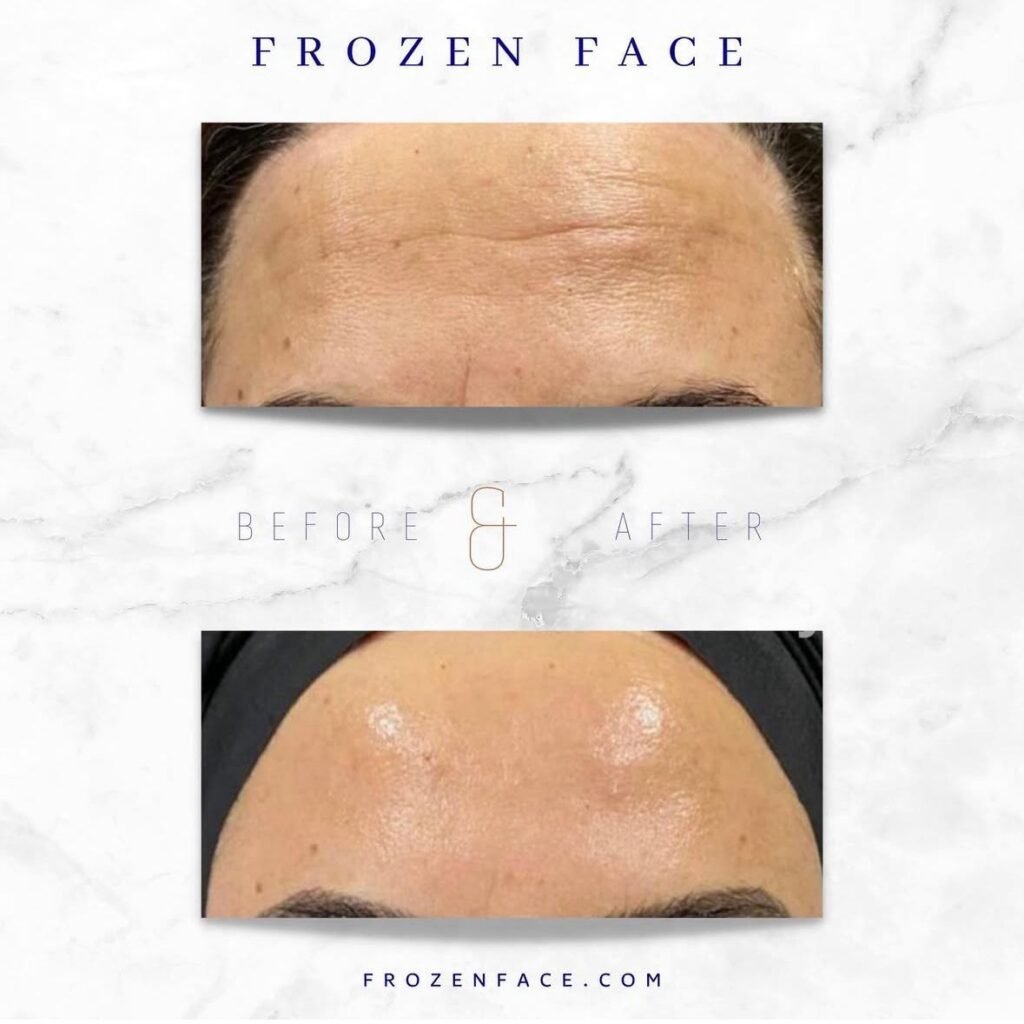 Frozen Face 1